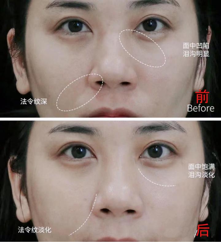 童颜针改善对比为什么有些姐妹打了针剂后,效果不明显?