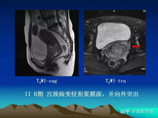 子宫常见疾病的MRI诊断 - 知乎