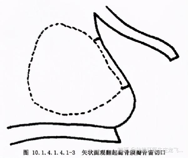 切口,從上頜尖牙到第一磨牙齦頰溝橫行切口,切開黏膜,骨膜,分離翻起黏