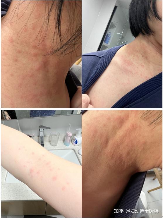 除了脸和小腿,我突然全身长满了这种皮疹,具体什么时候开始的我也不