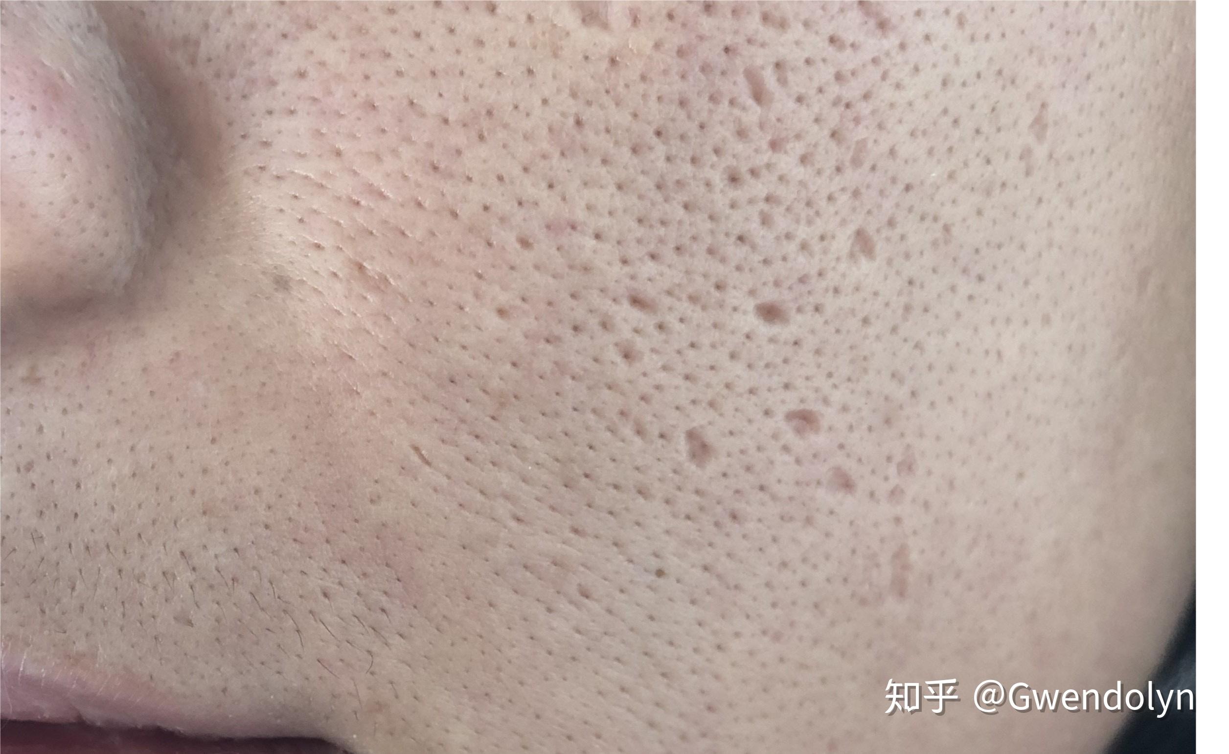 毛孔粗大到底有没有救啊啊啊啊啊啊,求方法!谢谢万能的知乎!!!? - 知乎