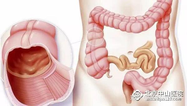结肠炎不治疗会有什么危害 知乎