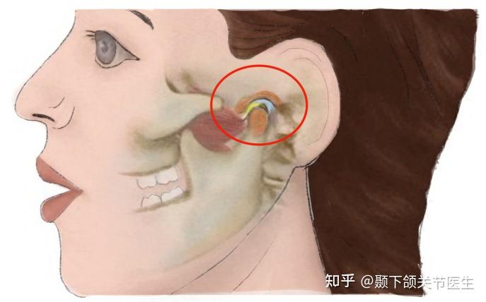 什么是颞下颌关节紊乱病? - 知乎