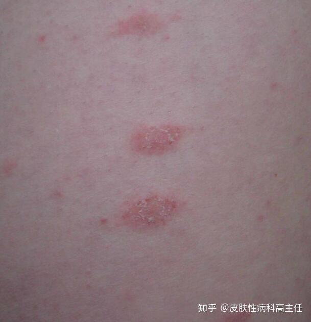 玫瑰糠疹和体癣的区别图片