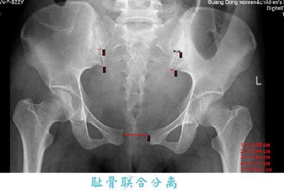 盆骨痛