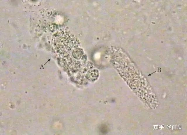 颗粒管型指管型基质内含有大小不等的颗粒物,颗粒含量超过管型体积的