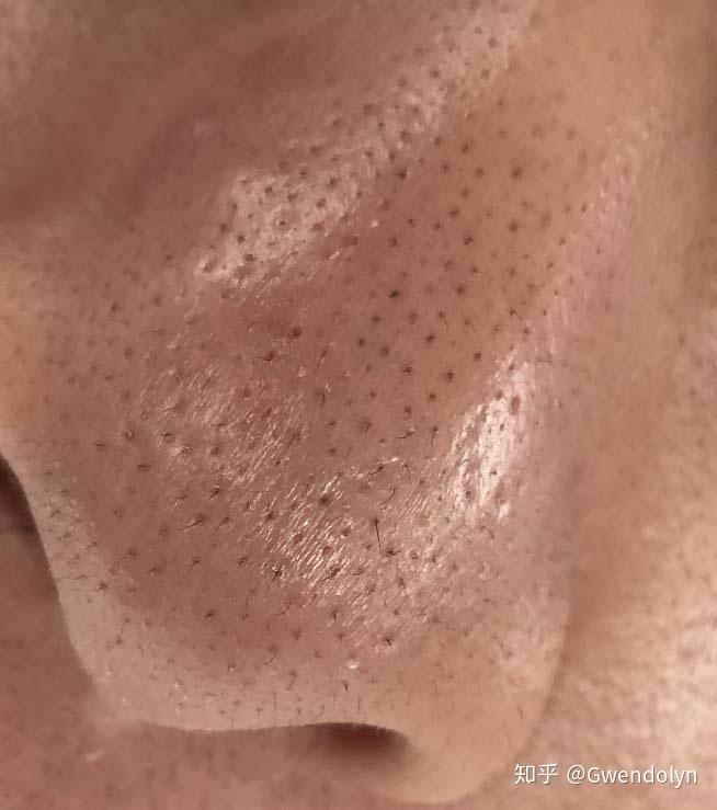 请问这种黑头如何去除