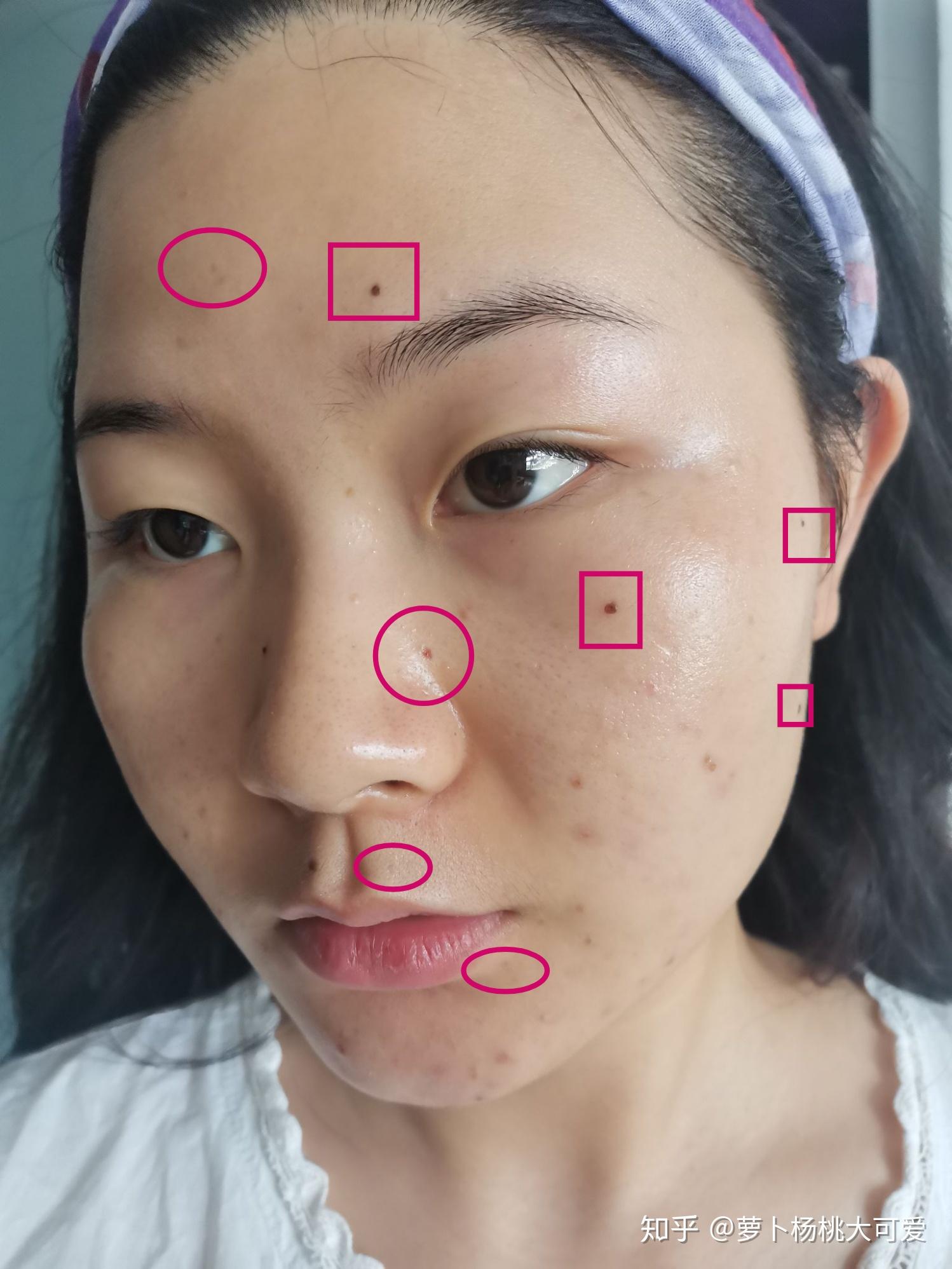 去医院做激光去痣需要多少钱