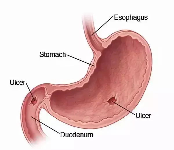 他喝下充满细菌的培养液,以身试"毒"竟试出百年医学谜题