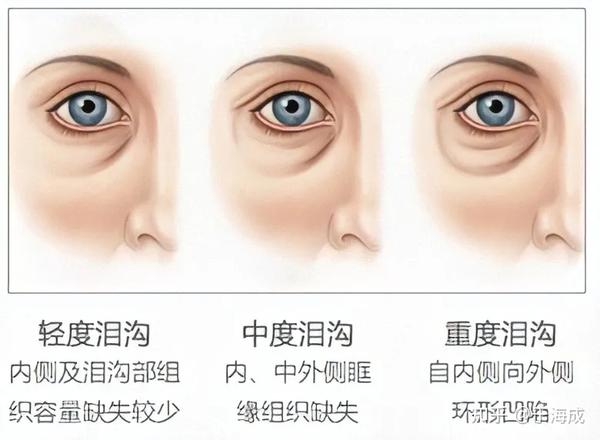 科普 | 填泪沟别踩坑!这样做,教你轻松解决 - 知乎