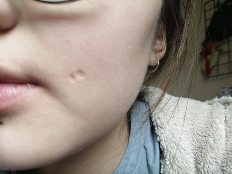 小时候点的痣,就是在诊所好像不太靠谱的地方,医生当时拿牙签蘸着那种