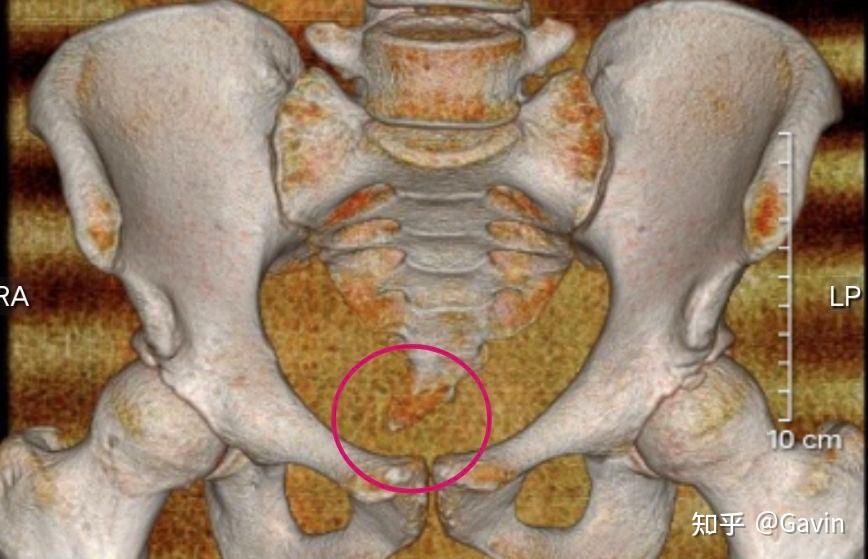 大腿腹股沟淋巴瘤图片图片