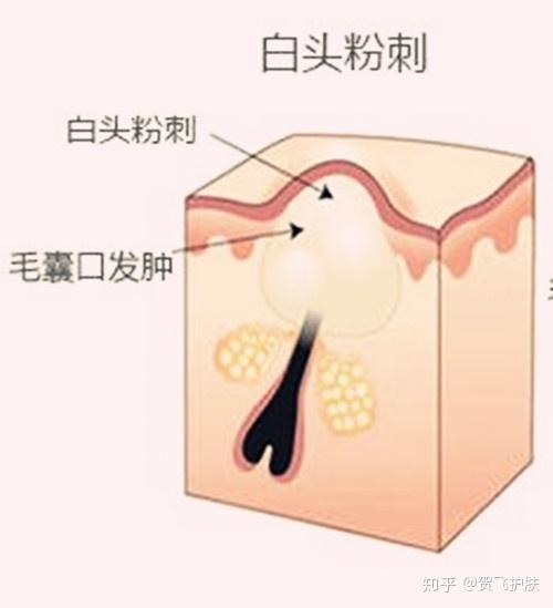 白头与黑头粉刺的形成