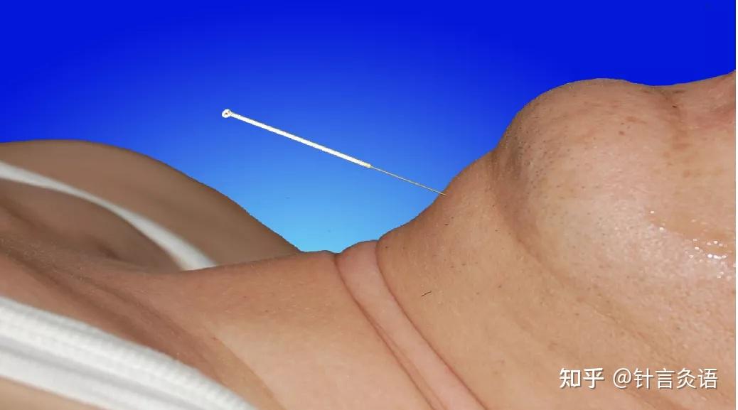 中风系列│石学敏院士醒脑开窍针刺法