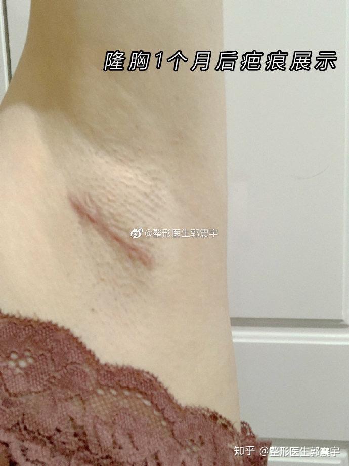 这个切口就是我们在腋下,这也是我们隆胸手术目前最常见的切口位置.
