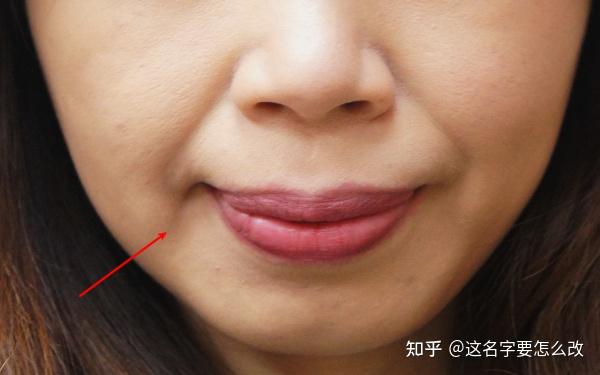 木偶纹,又称支架纹,流涎纹,是指长在嘴角两侧的皱纹,在嘴角外侧或下方