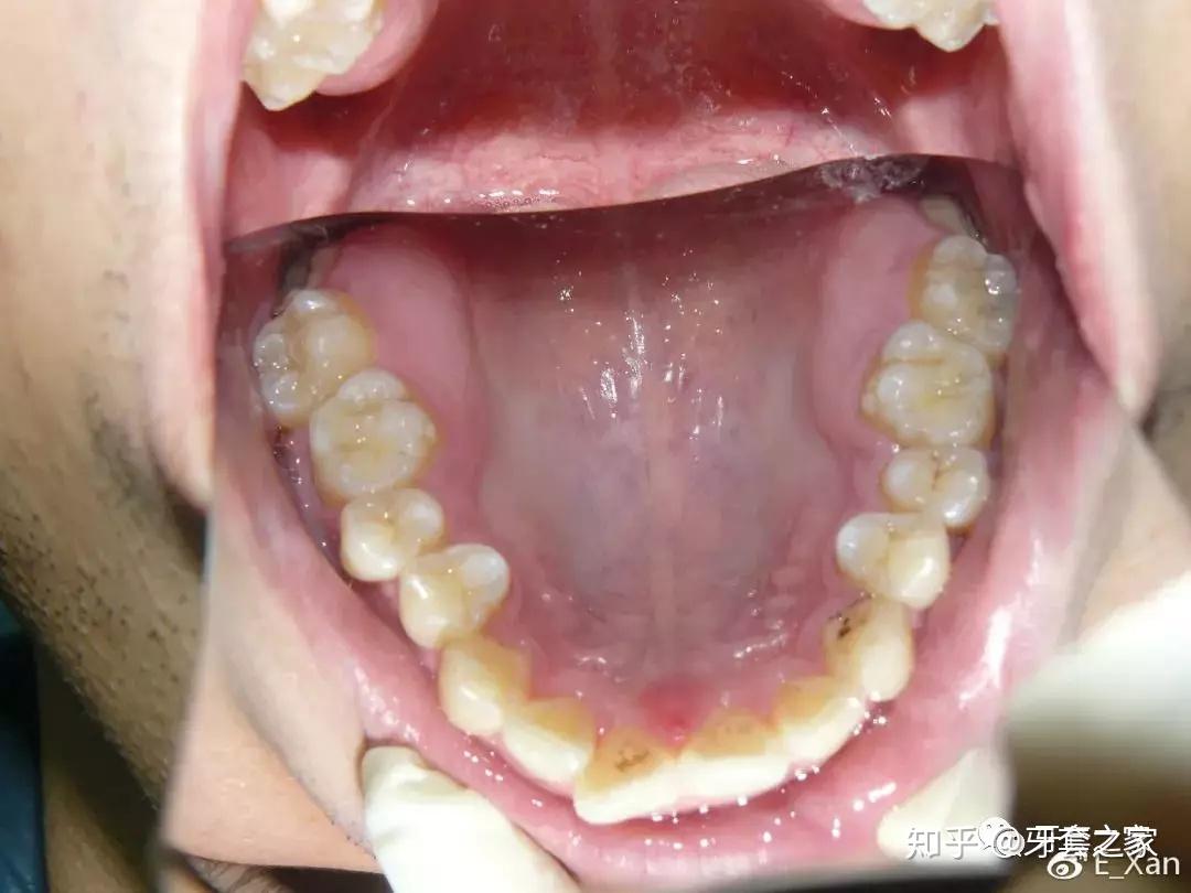 牙齿缝隙大如何矫正(门牙缝隙变大什么原因) - 科猫网