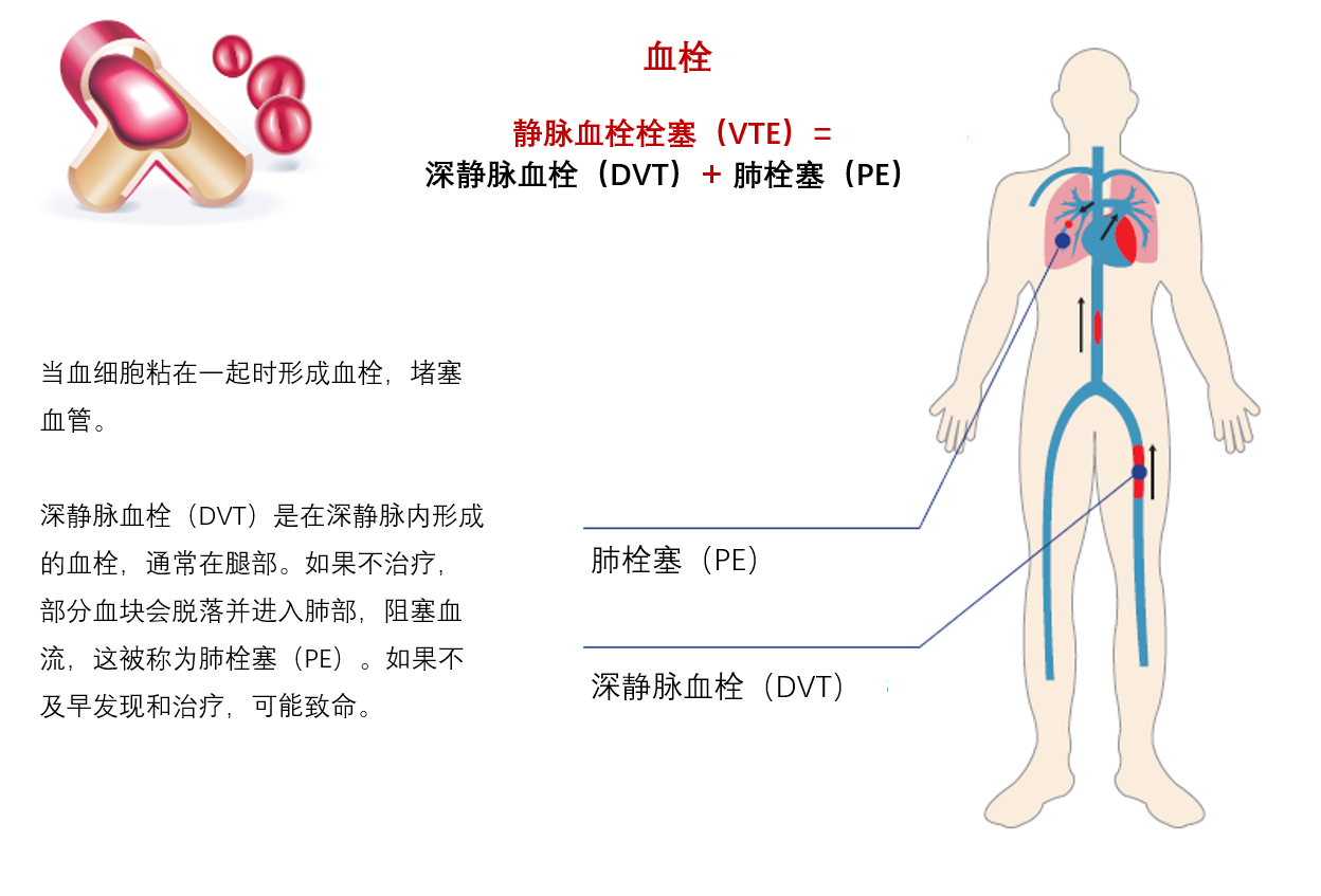 癌症相关血栓的发病风险 危害和诊断 知乎