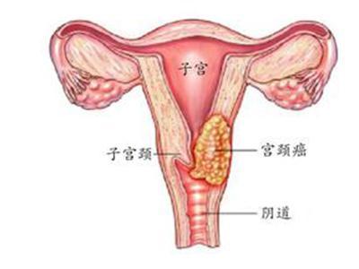 宮頸癌的治療方法和飲食宜忌