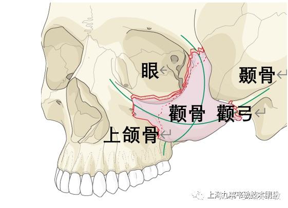 九院韦敏 | 颧弓颧骨内推后,会容易骨折吗? - 知乎