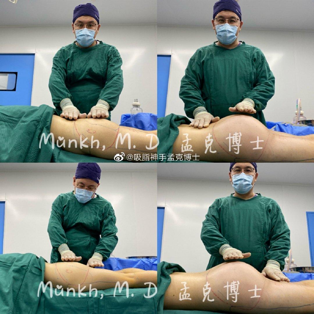 自体脂肪丰臀要填充几次才有效果