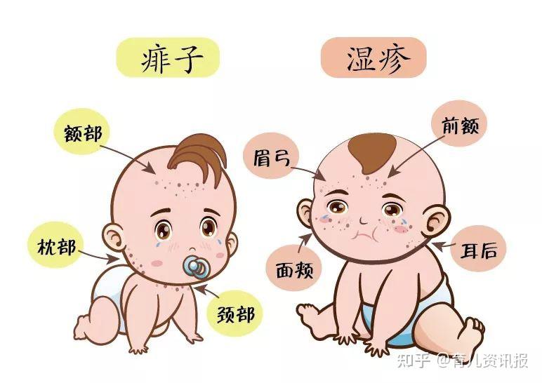 天气热宝宝总是长痱子怎么办? - 知乎