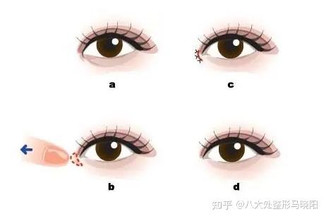 1次搞懂内眦vs外眦! - 知乎