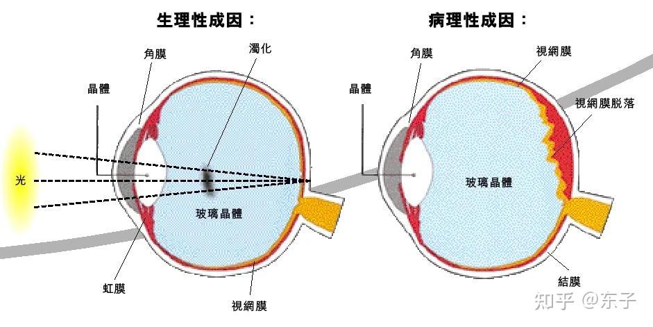 你知道吗飞蚊症可以治疗