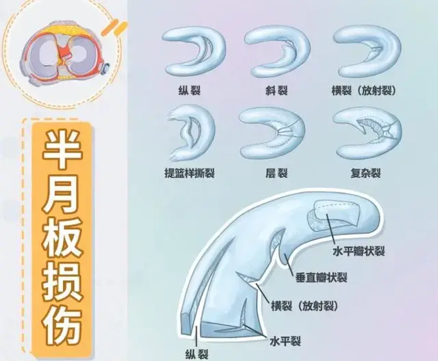 5种情况怀疑半月板撕裂:半月板损伤可能会导致关节积液,未经处理的,大
