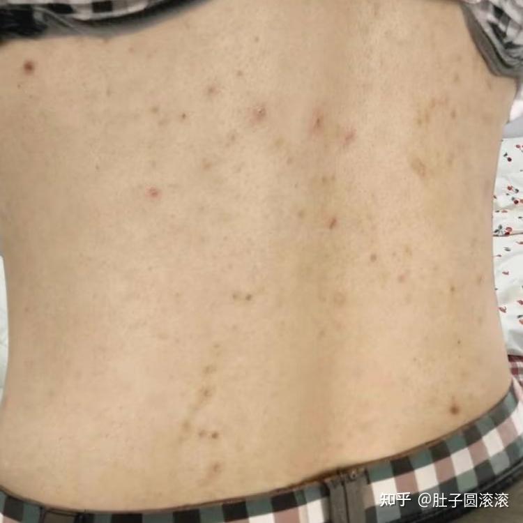 同居之后发现男朋友背上全都是痘痘,会不会传染给我啊? - 知乎