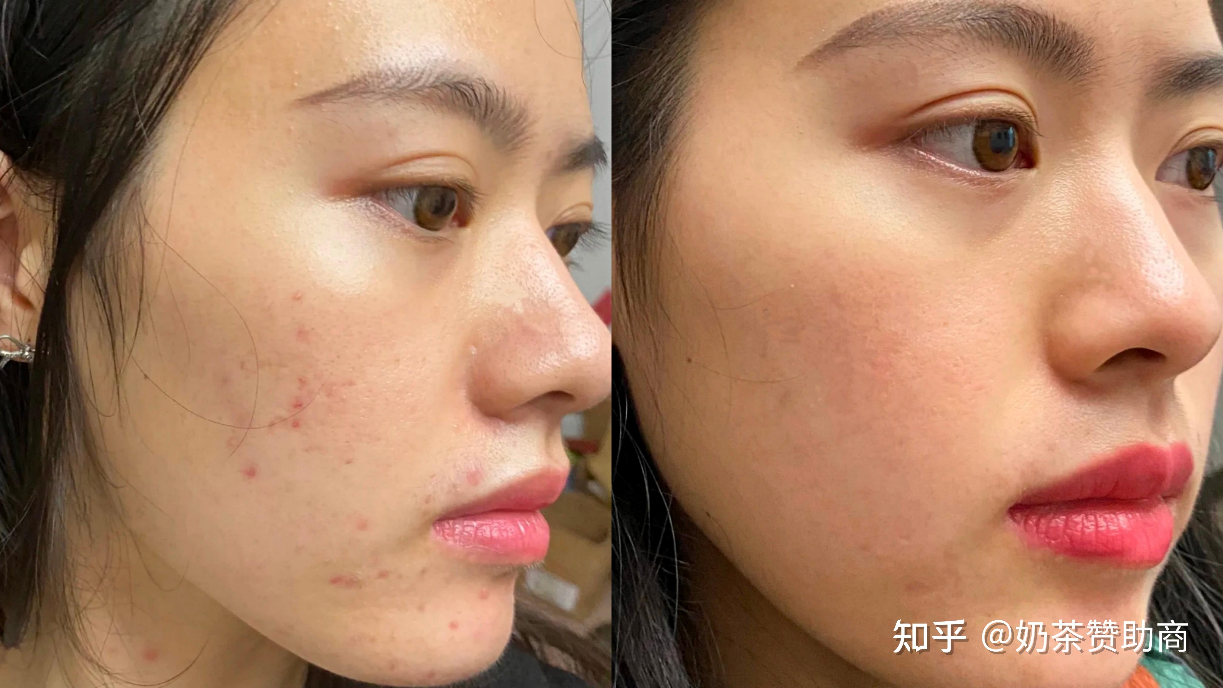 俏诺薇水杨酸祛痘膏