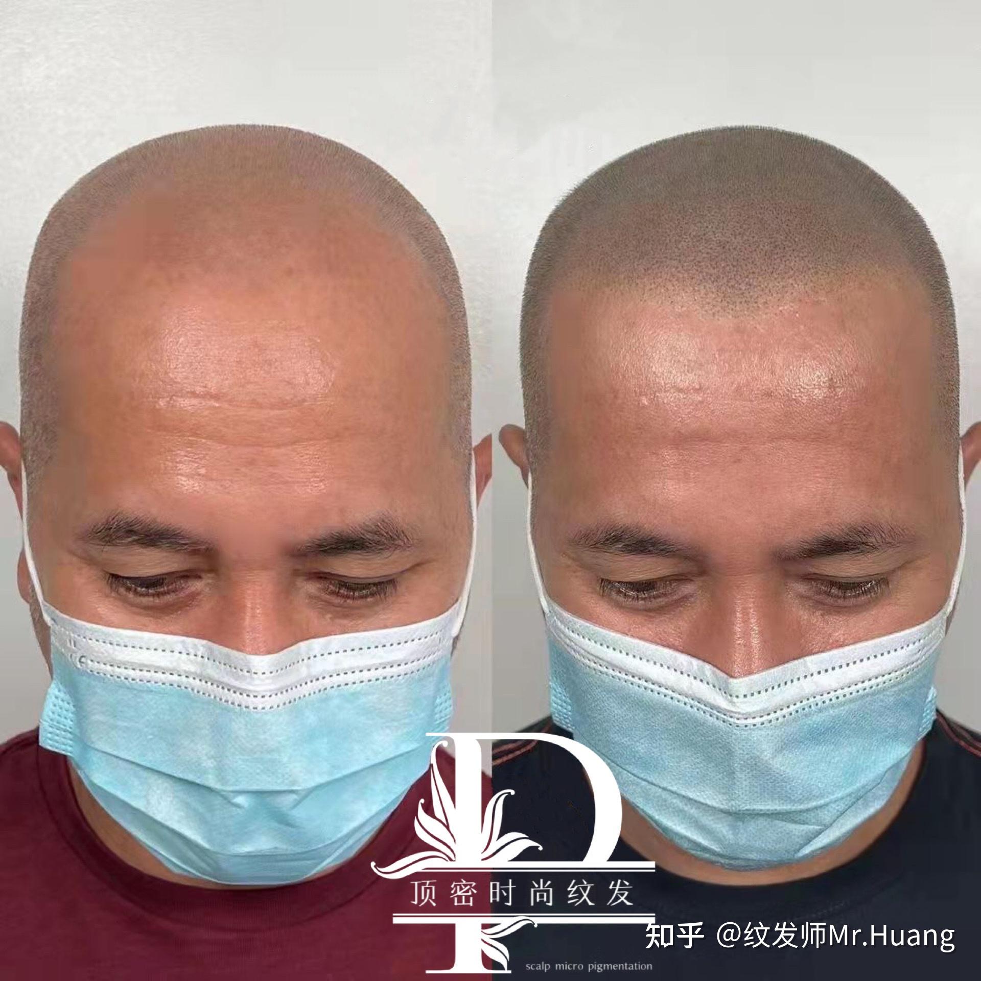 纹发疼不疼福建顶密时尚纹发黄老师全面解析