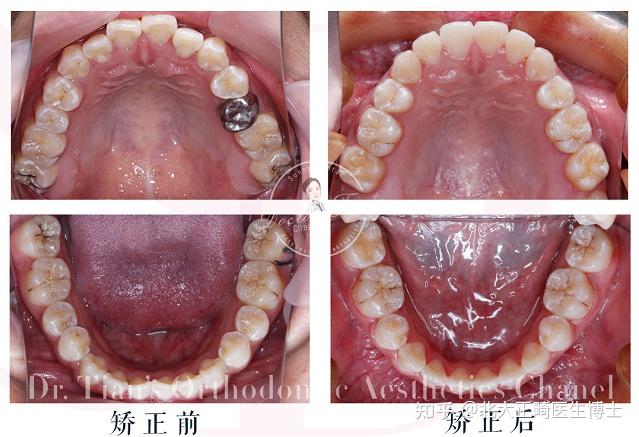 直面型和微凸面型图片