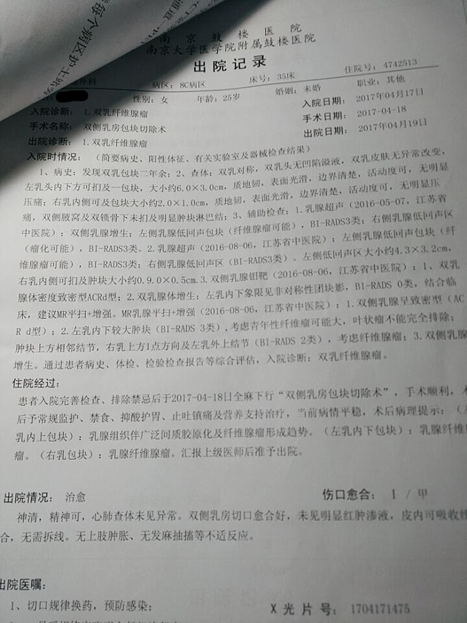 乳腺纤维瘤 - 知乎