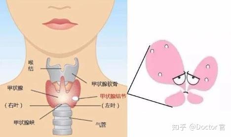甲状腺结节1厘米需要手术吗?