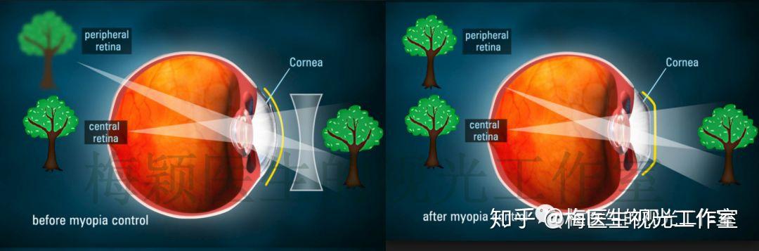 角膜塑形控制近视进展的原理和效率