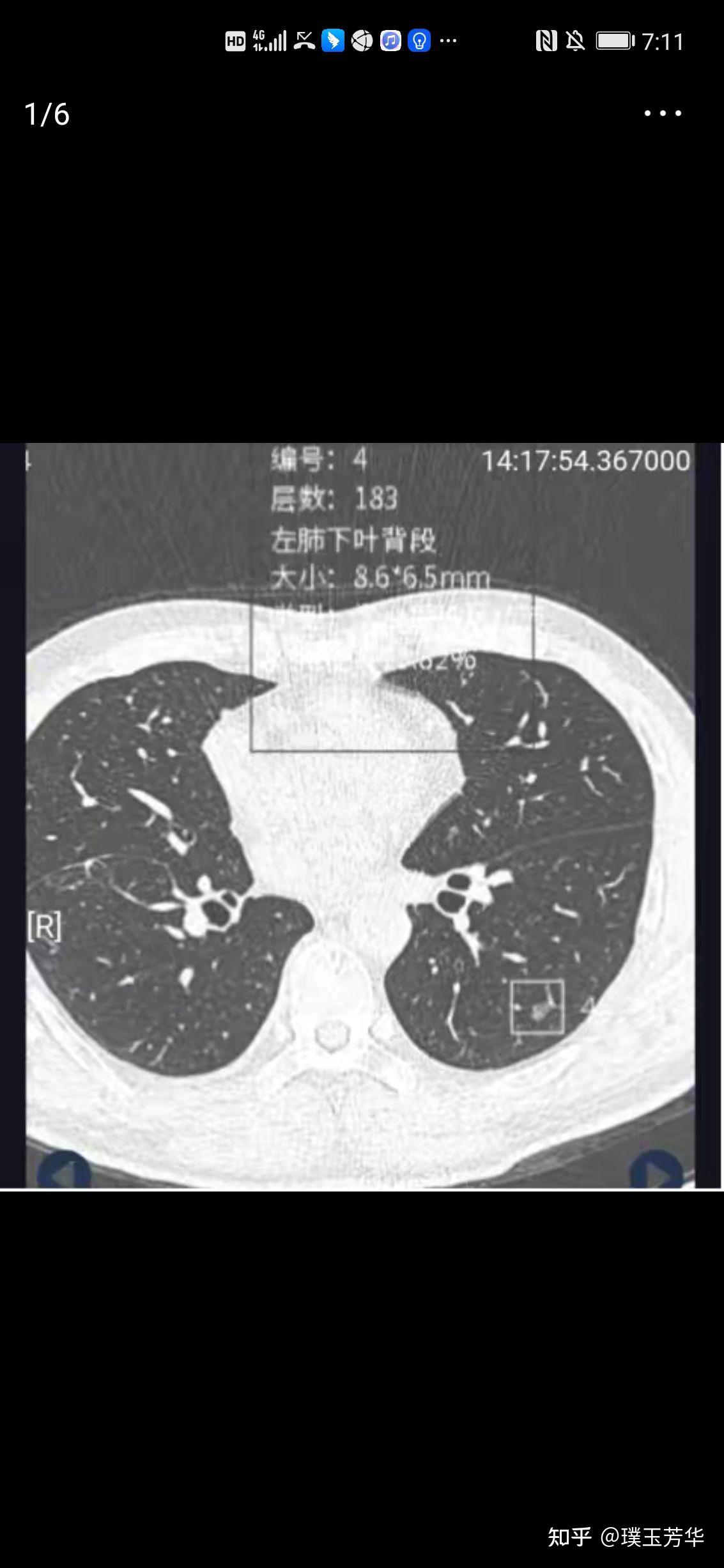 多發磨玻璃肺結節有的增生有的微浸潤腺癌手術還是再等等