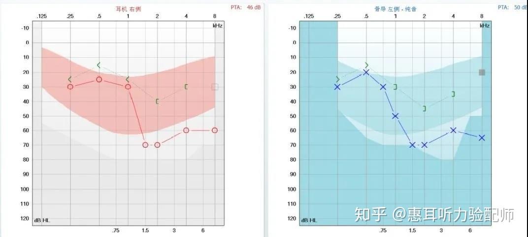 雙模干預人工耳蝸與助聽器的雙耳雙模式干預綜述解讀上