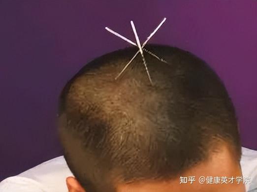 带你了解中医针灸“靳三针”疗法:三针秒杀绝技! - 知乎