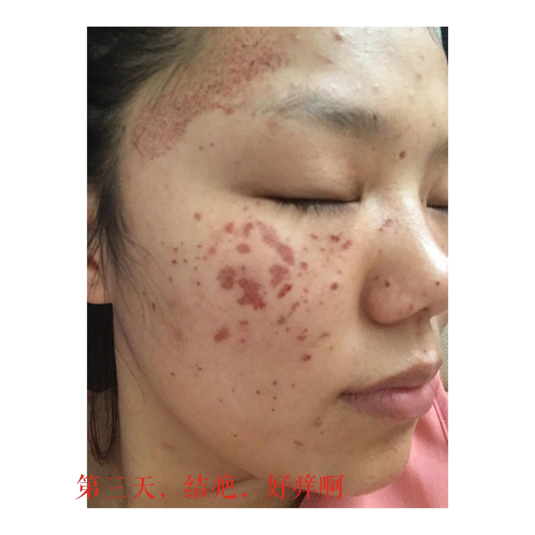 有人激光治疗过颧骨褐青色痣吗