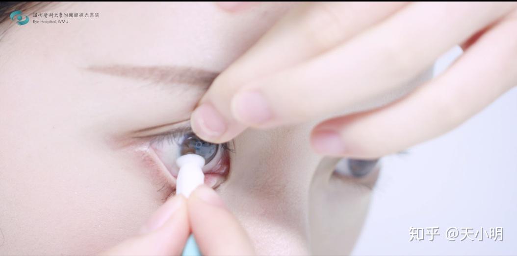 不可忽视的角膜塑形镜护理护理步骤值得收藏