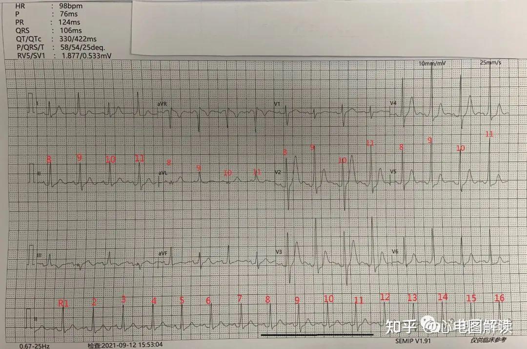 圖1圖1-3是同一個人,圖1是普通心電圖,圖2,圖3是動態心電片段.