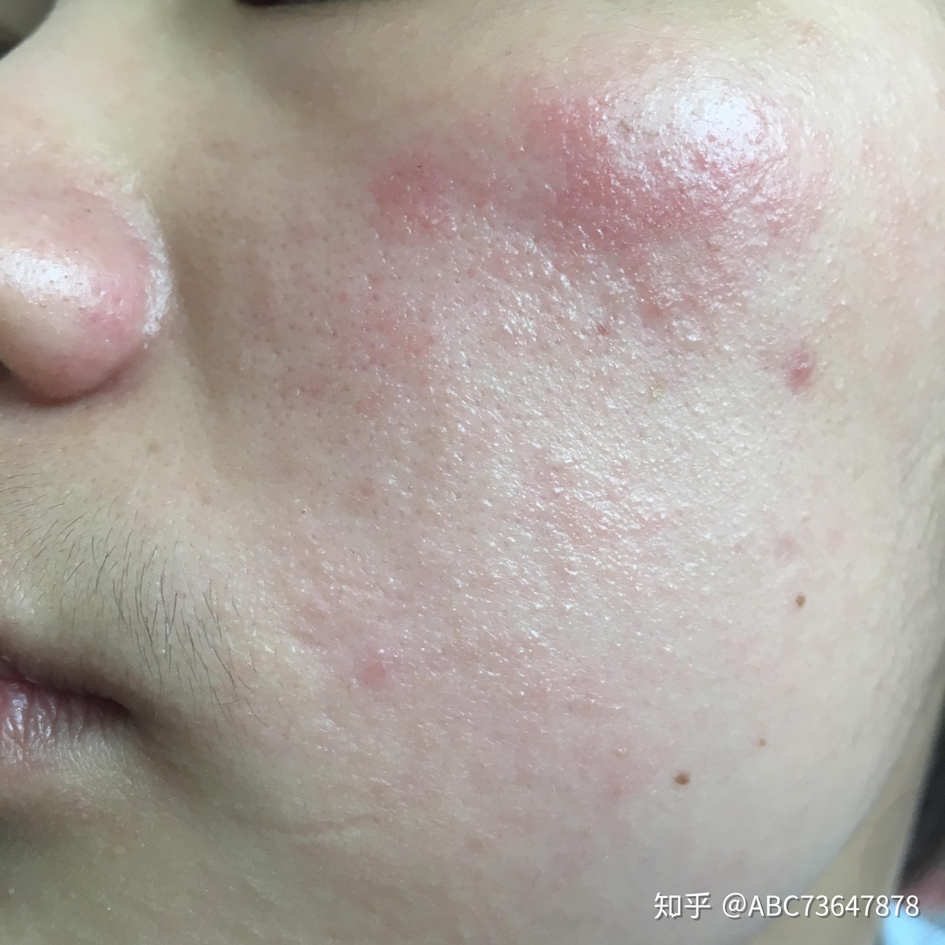 期间3月份脸部的状态后来自己耳后测试了,知道了是口红过敏,把香奈儿