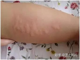 超全 11种宝宝最常见的皮肤疹子护理方法 赶快收藏 知乎