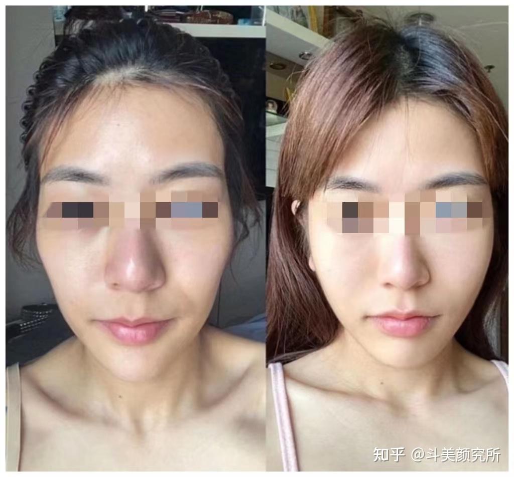 面颊凹陷的原因是什么?如何才能有效改善