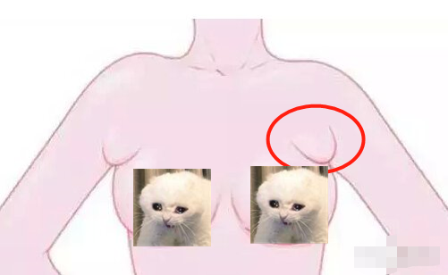 关于副乳的危害你知道多少吸除副乳和切除副乳哪一种方法会更好呢