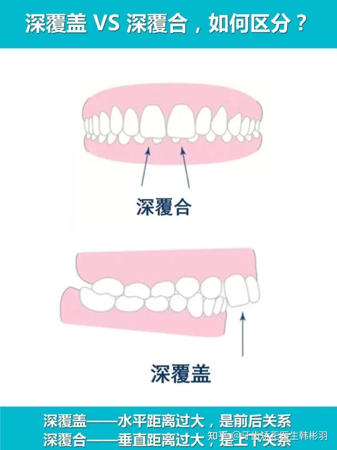 深覆盖和深覆合图解图片