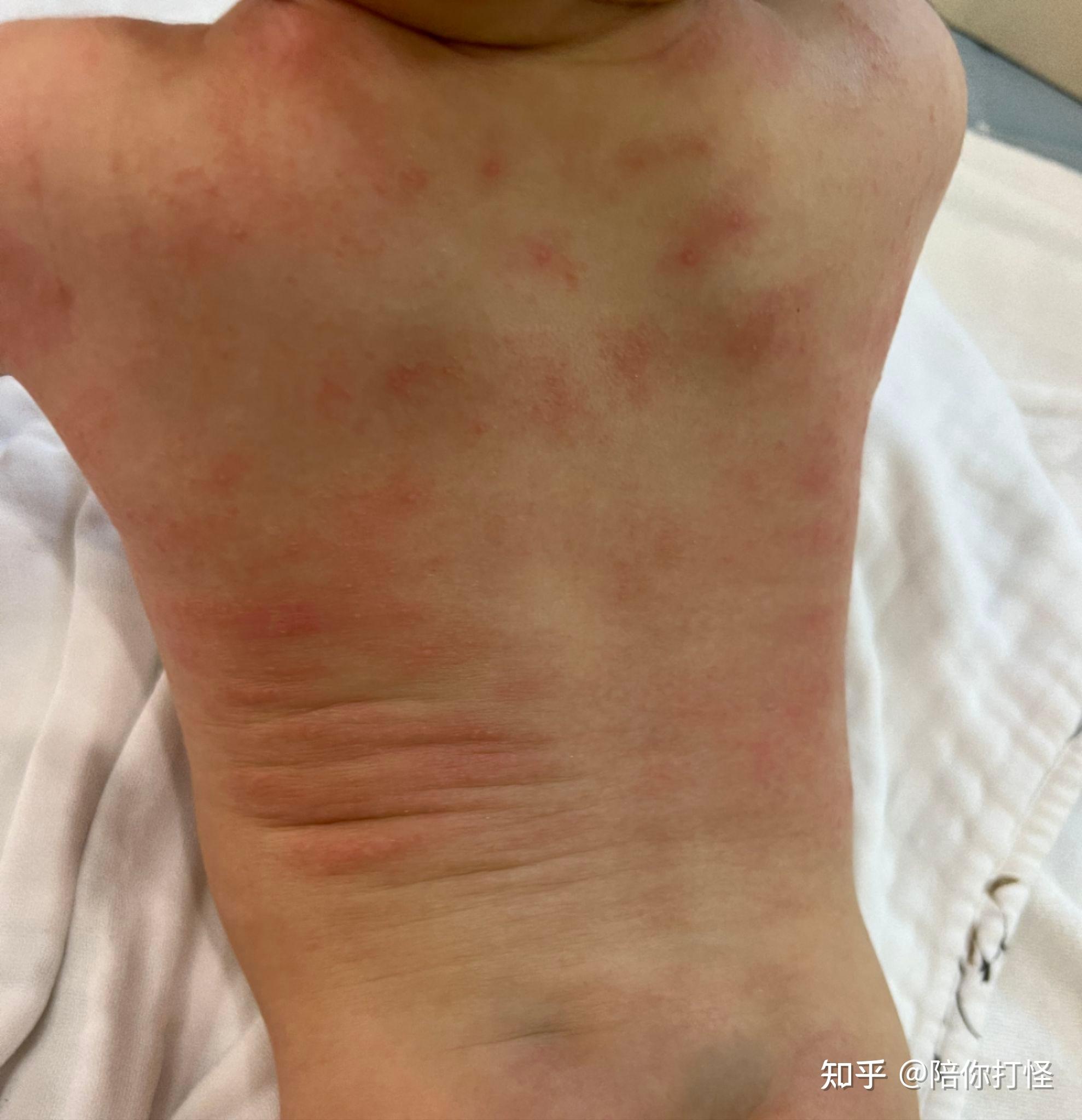 【代诊】四个月的宝宝全身湿疹 特应性皮炎 - 知乎