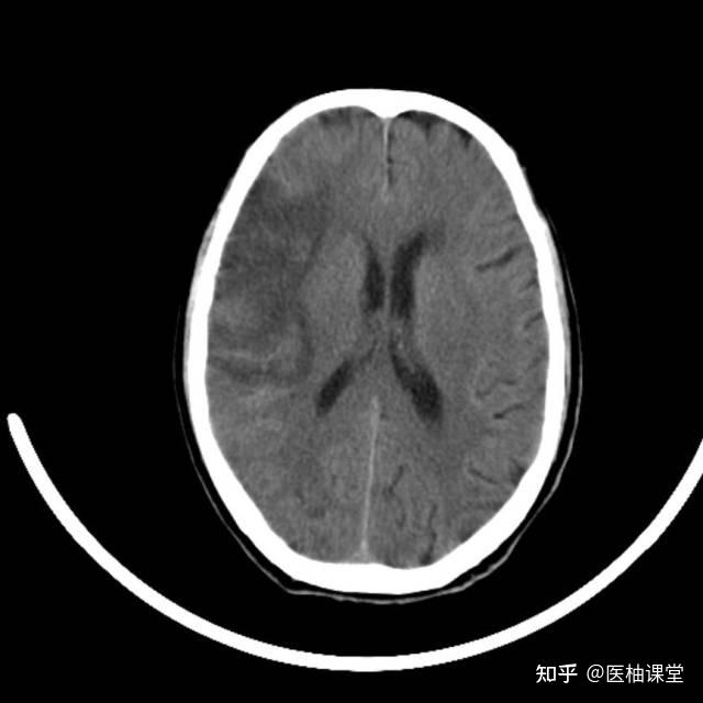 CT看脑梗：掌握这五大征象 - 知乎