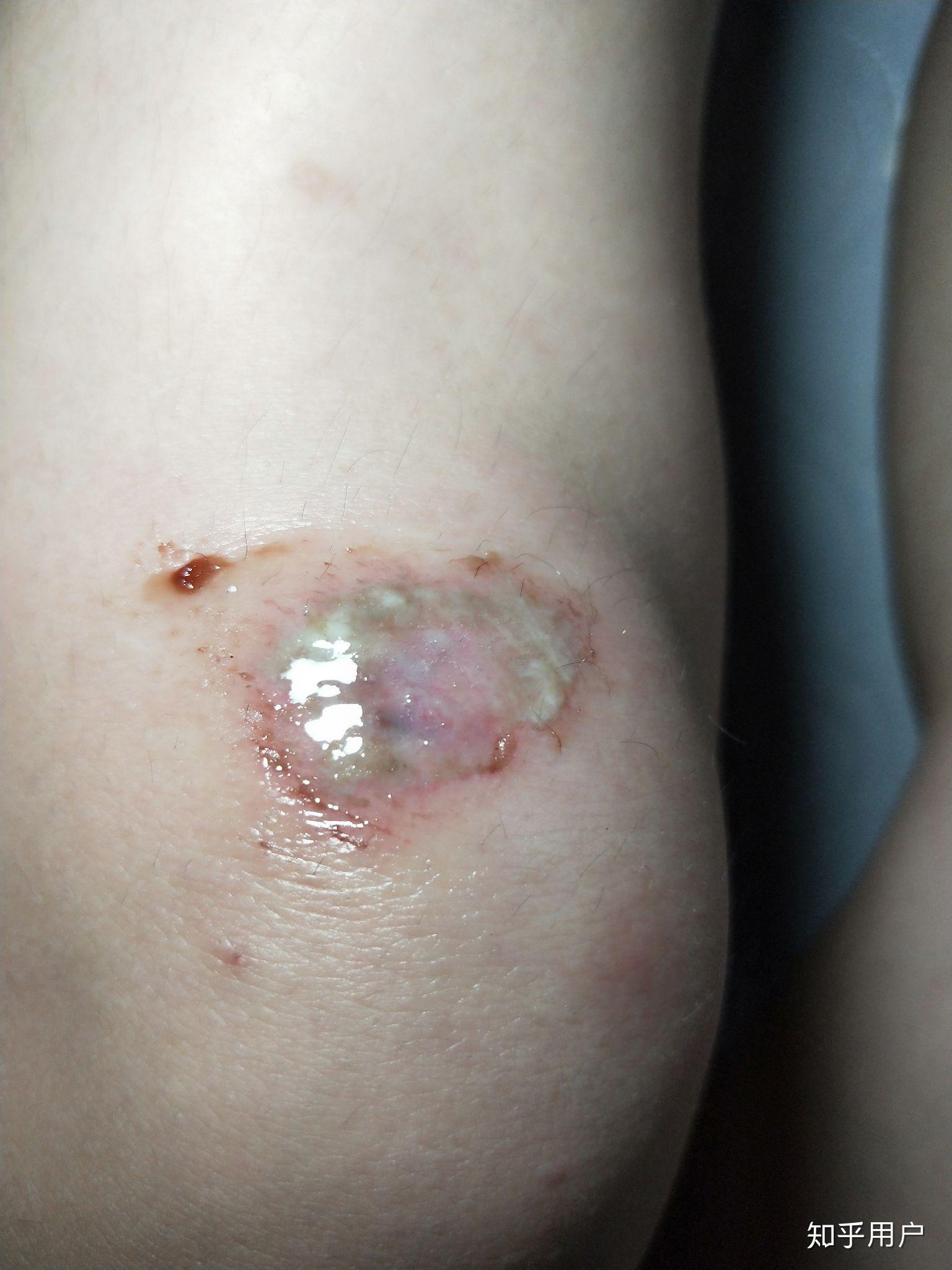 擦伤后的处理伤口化脓了